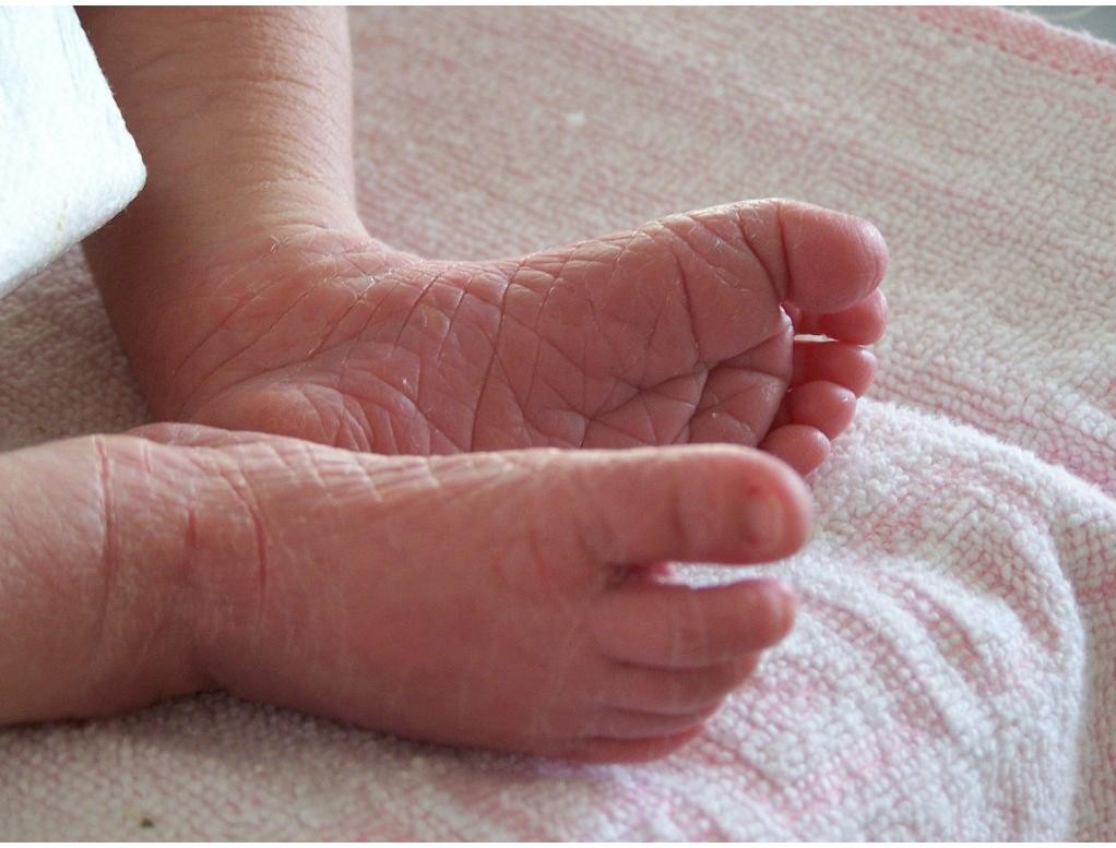 Neurodermitis en eczeem bij baby's en kinderen